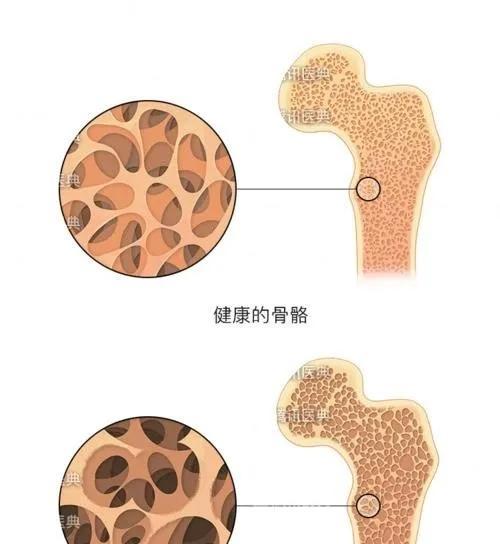 净水器导致骨质疏松的预防与治疗（净水器健康隐患揭秘）